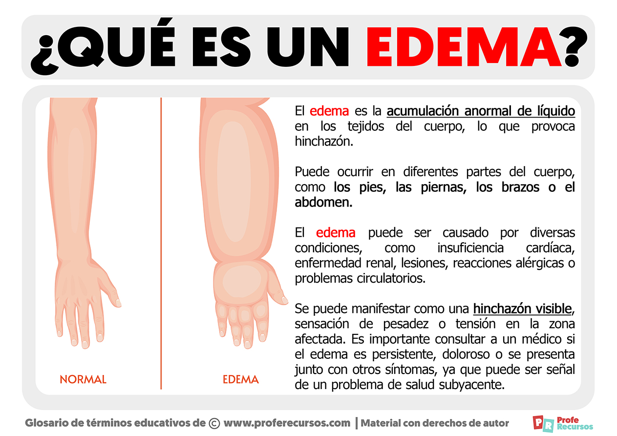 Qu Es Un Edema Definici N De Edema