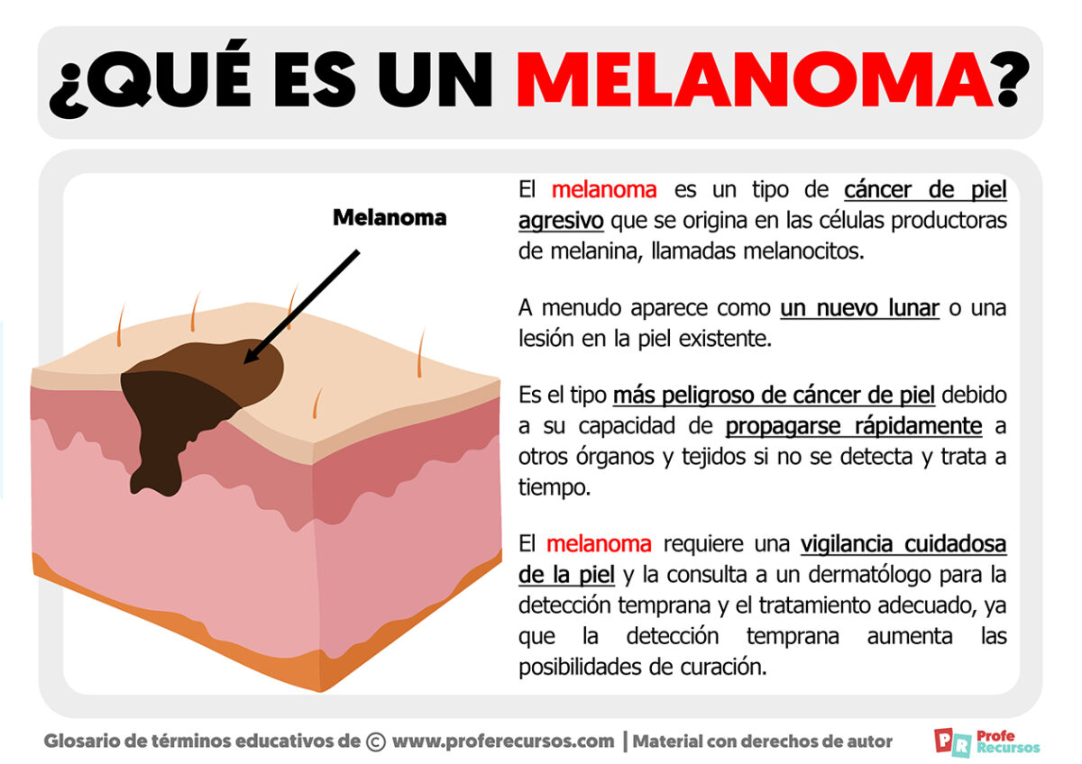Qué es un Melanoma Definición de Melanoma